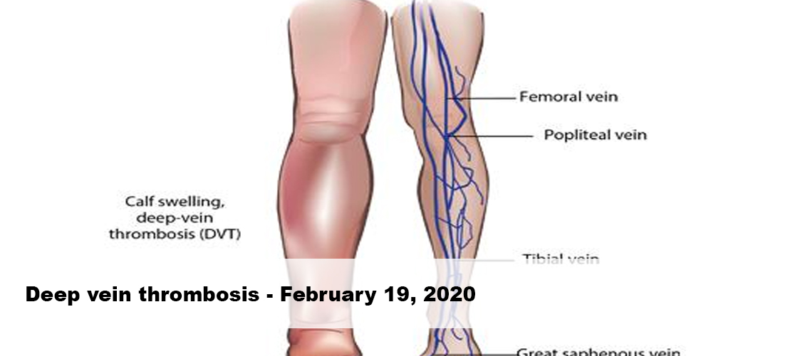 AHS FEBRUARY 2020 UPDATE – Deep vein thrombosis
